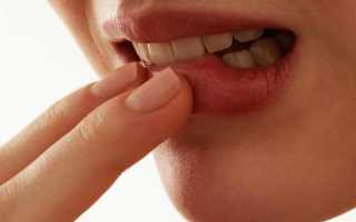 Кандидомикоз полости рта — симптомы, причины, методы лечения