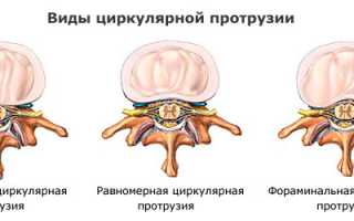 Циркулярная протрузия диска, что это такое?