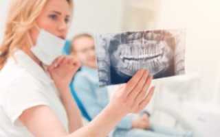 Альвеолит: признаки и лечение воспаления лунки зуба