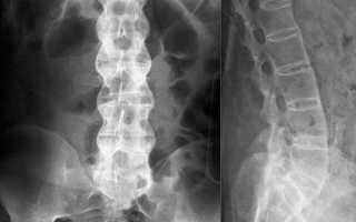 Рентген позвоночника — что показывает?