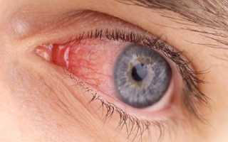 Как проявляется гиперемия конъюнктивы глаза? Как лечить заболевание?