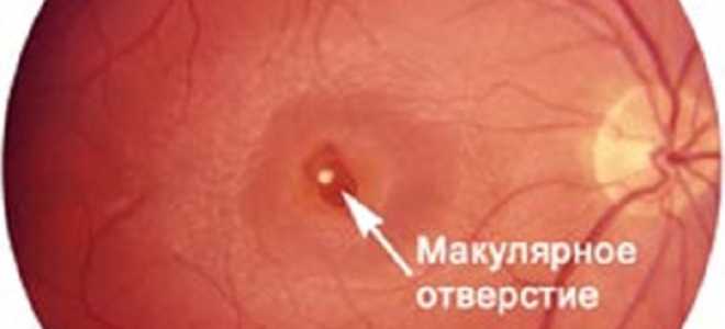 Макулярный разрыв сетчатки: единственный способ исправить дефект — хирургическое вмешательство