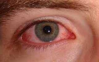 Симптомом каких болезней могут быть красные белки глаз у взрослого?