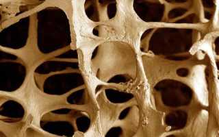 Диффузный остеопороз