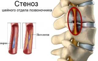 Сужение сосудов шейного отдела позвоночника