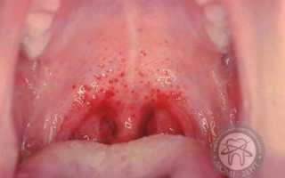 Язвочки во рту и их лечение