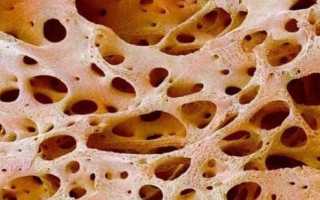 Остеосклероз позвоночника: что это такое?