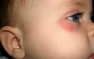 Почему может возникать покраснение вокруг глаза у взрослого или ребенка и как его лечить?