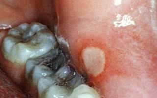 Язвы в полости рта – клинические признаки при различных заболеваниях