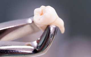 Почему не останавливается кровь после удаления зуба?