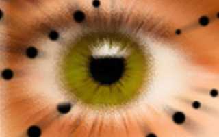 Почему летают черные точки перед глазами? Причины и лечение недуга