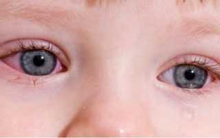 Как проявляется конъюнктивит у детей: симптомы, признаки и причины заболевания глаз