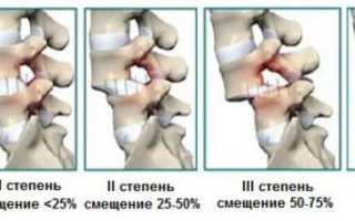 Антелистез L4 позвонка – что это такое