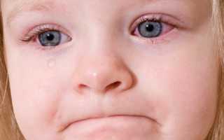 Почему покраснели белки глаз у ребенка? Как справиться с таким симптомом?