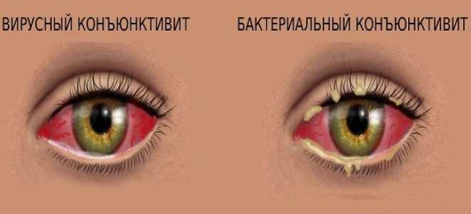 Бактериальный и вирусный конъюнктивит: как отличать эти формы заболевания