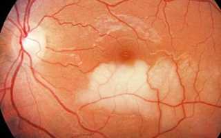 Разрыв сетчатки глаза — серьезно ли это? Можно ли избежать заболевания?
