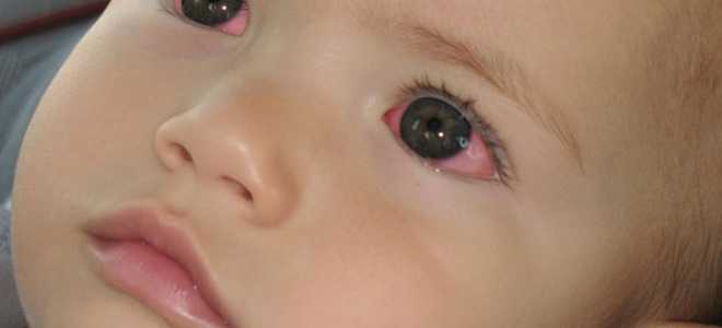 Почему у ребенка может быть красный глаз без гноя?