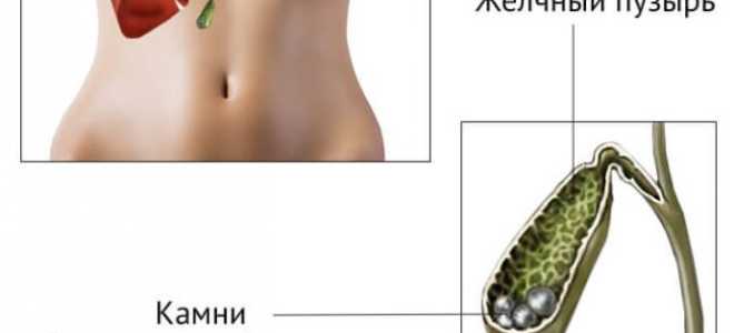 Дробление камней в желчном пузыре как метод лечения ЖКБ