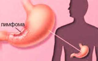Лимфома кишечника: симптомы, которые должны насторожить