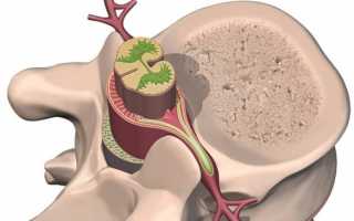 Невринома позвоночника