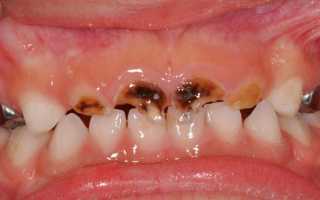 Как кариес разрушает наши зубы. Этапы развития кариеса.