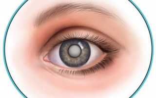 Чем сопровождается начальная стадия катаракты, лечение лекарственными препаратами, каплями и народными седствами