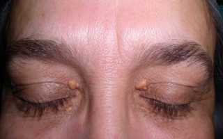 Как избавиться от жировиков на веках глаз? Медикаментозное и хирургическое лечение
