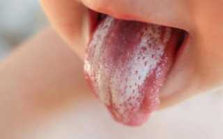 Белый налет на языке у малыша: 5 распространённых причин