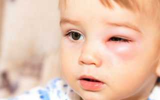 Чем вызван у ребенка ячмень на глазу: лечение у детей в возрасте 2-3 года и старше
