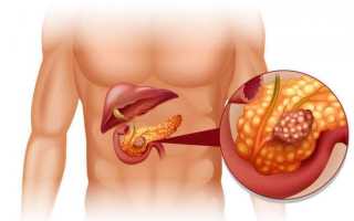 Аденокарцинома поджелудочной железы — прогноз при опухоли и методы ее устранения