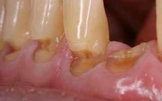 Цемент зуба: строение и функции. Общая характеристика и интересные факты