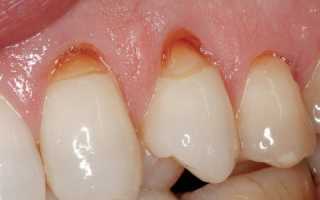 Клинические проявления аномалий цвета постоянных зубов человека