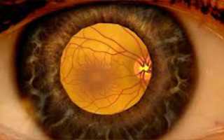 Макулярный отек сетчатки глаза — самые эффективные методы лечения