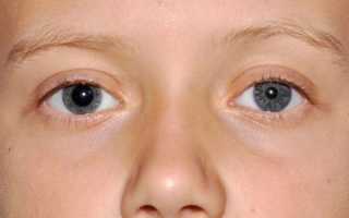 Когда и по каким причинам появляется анизокория у детей? Особенности лечения