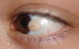 Что является причиной шишки на глазном яблоке и чем опасно такое проявление?