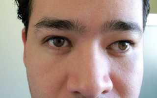 Как и почему развивается амблиопия (синдром ленивого глаза) у взрослых? Как лечить заболевание?