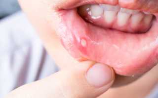 Диетотерапия при заболеваниях полости рта