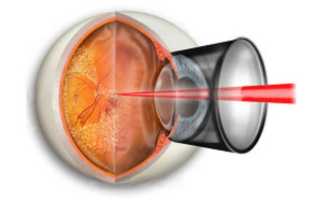 Особенности проведения лазерной коагуляции сетчатки глаза