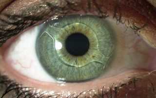 Что такое вторичная катаракта после замены хрусталика: лечение лазером, профилактика