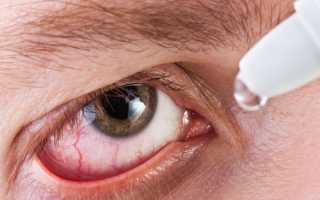 Воспаление роговицы глаза или кератит: лечение и профилактика каждого вида заболевания