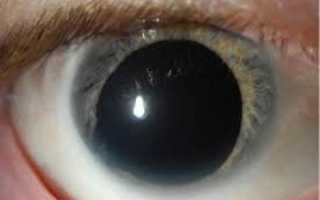 Афакия глаза — отсутствие в глазу хрусталика. Как восстановить зрение?