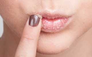 Кандидоз на губах: информация, этиология, возможные симптомы, диагностика и лечение