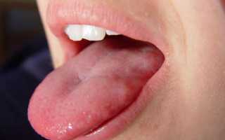 Налет на языке при гастрите – симптомы, дифференциальная диагностика, методы лечения, причины появления