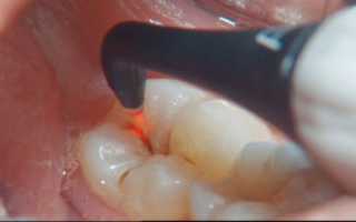 Можно ли проводить ультразвуковую чистку зубов, если есть кариес?