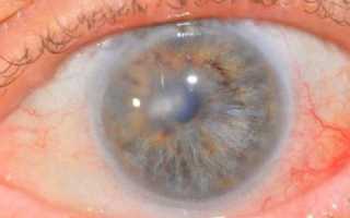 Что такое кератопатия? Какова вероятность восстановить зрение полностью?