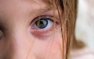 Каковы основные симптомы и причины ячменя на глазу у детей?