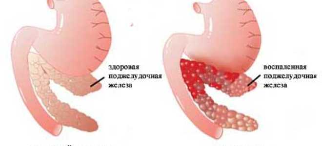 Классификация, лечение и симптомы грыжи пищевода