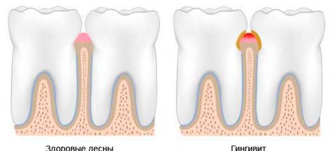 Как проявляется рак полости рта – симптомы заболевания