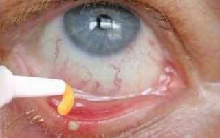 Как выбрать эффективную мазь для лечения ячменя на глазу? Список лучших препаратов