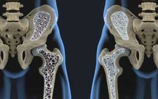 Остеопения и остеопороз: разница